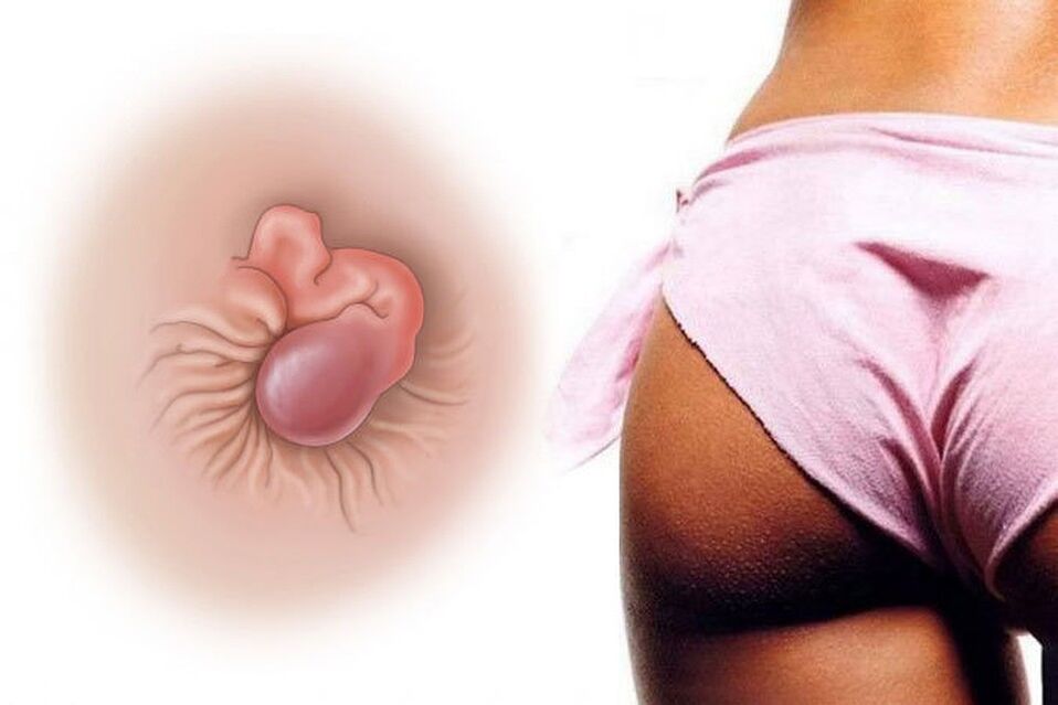 Creme natural cura hemorróidas em um curso