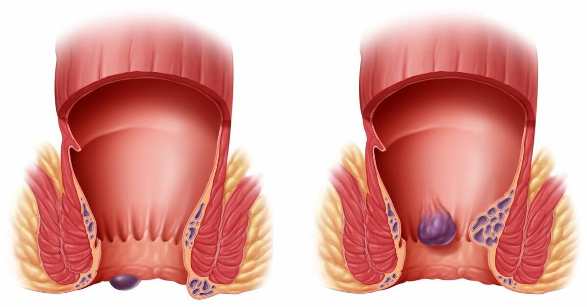 Gelarex ajuda com hemorróidas internas e externas
